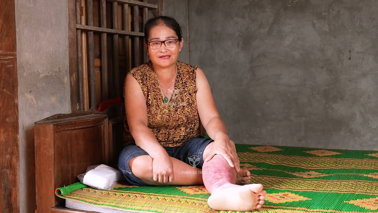 Cô Luyễn Điều trị suy giãn tĩnh mạch sau 3 tháng dùng cao Tuân Mạch Linh