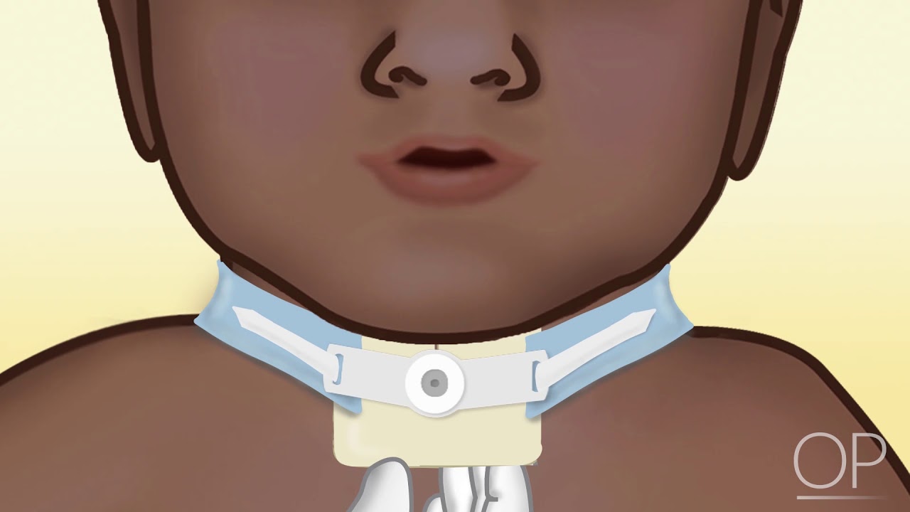 Tracheostomy Site Care by J. Nobrega | OPENPediatrics