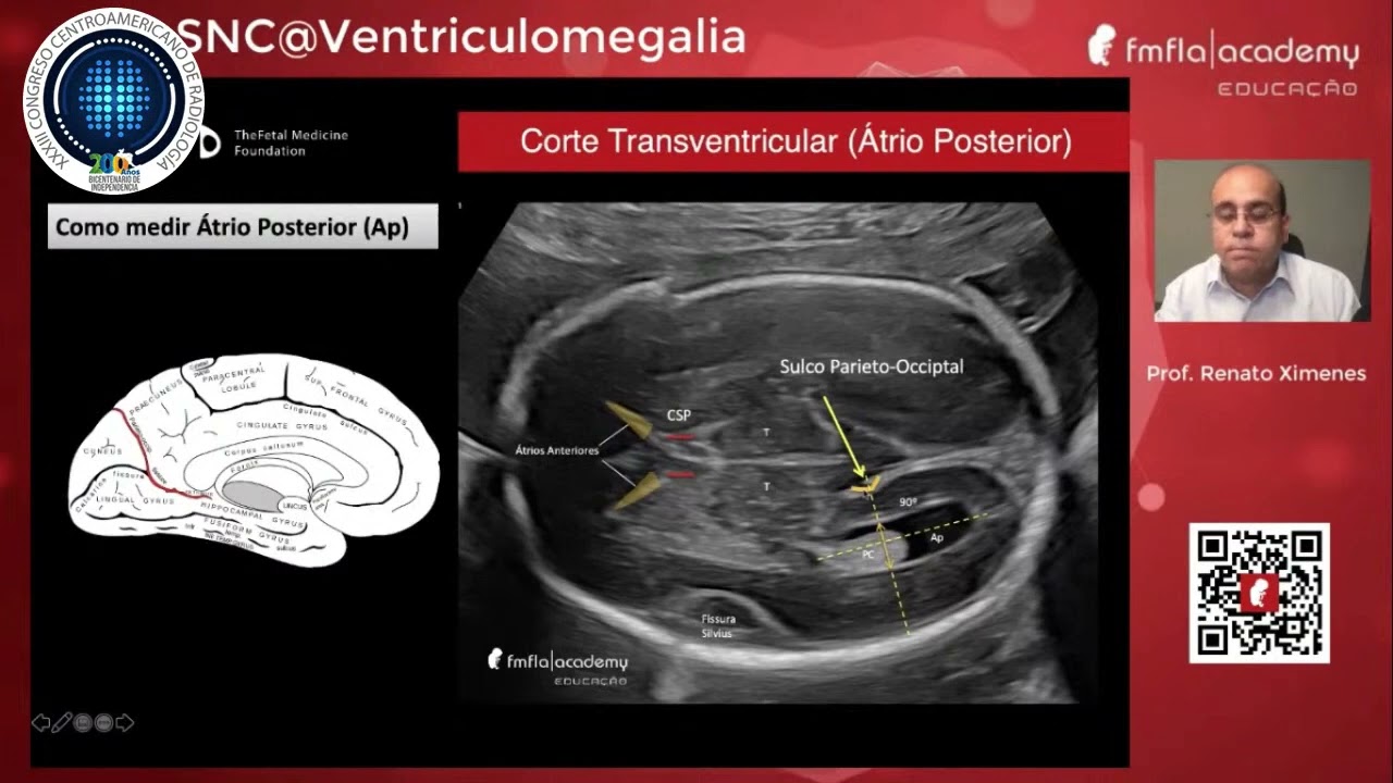 Ventriculomegalia fetal - Dr Ximenes