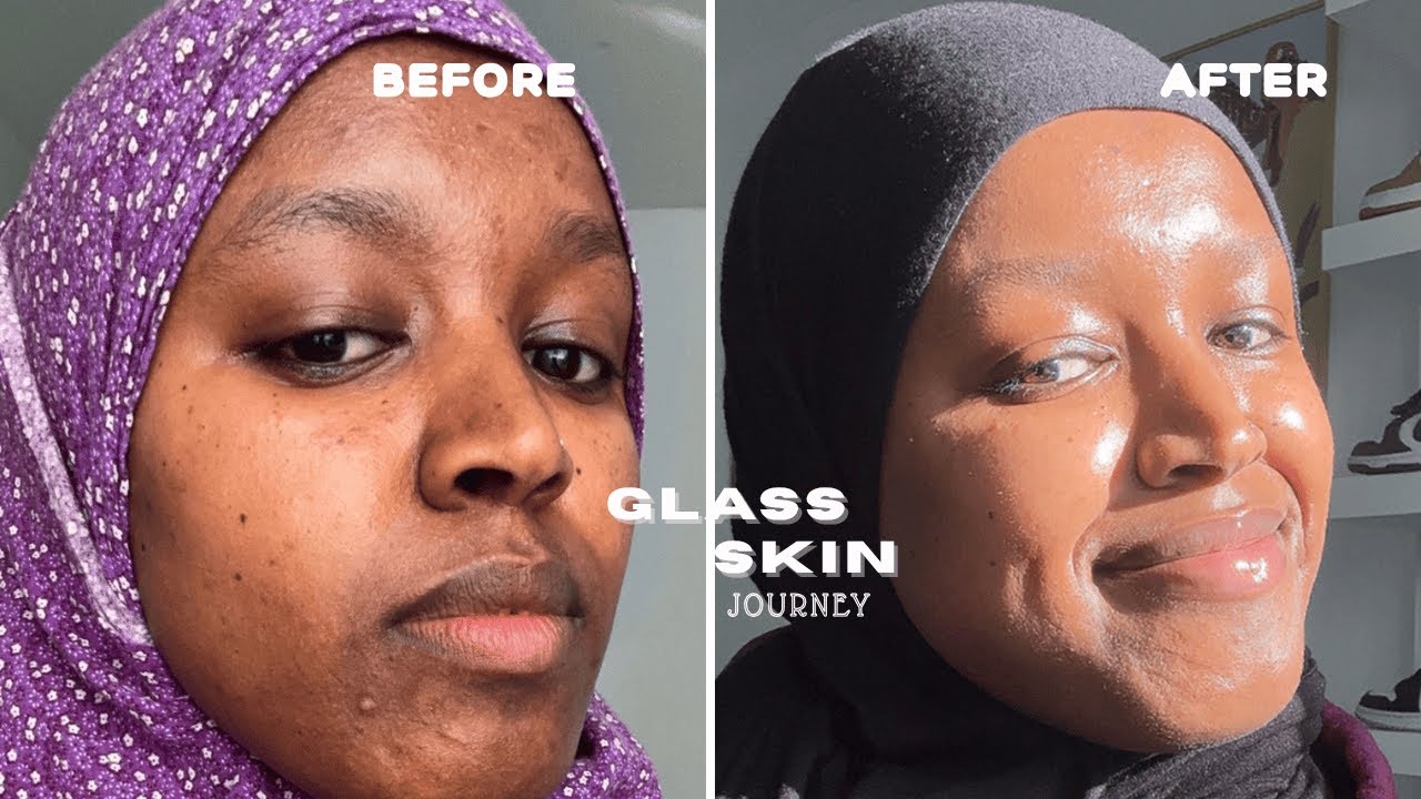 HOW I CLEARED MY HYPERPIGMENTATION, DARKSPOTS, & ACNE!| GLASSSKIN ROUTINE