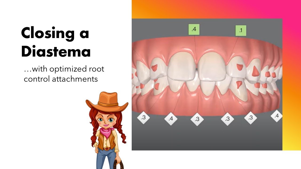 Invisalign ClinCheck - Closing a diastema with root control attachments