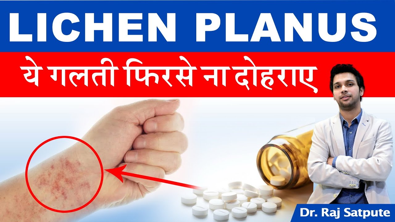 Lichen Planus क्यों होता है ? Lichen Planus होने के इन गलतियों को कभी नहीं दोहराई | Dr Raj Satpute