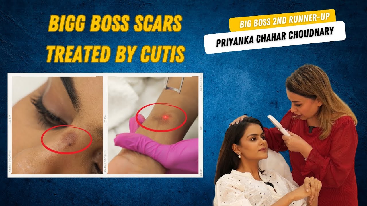 Bigg Boss Scars Treated By Cutis | Priyanka Chahar Choudhary | Big Boss16