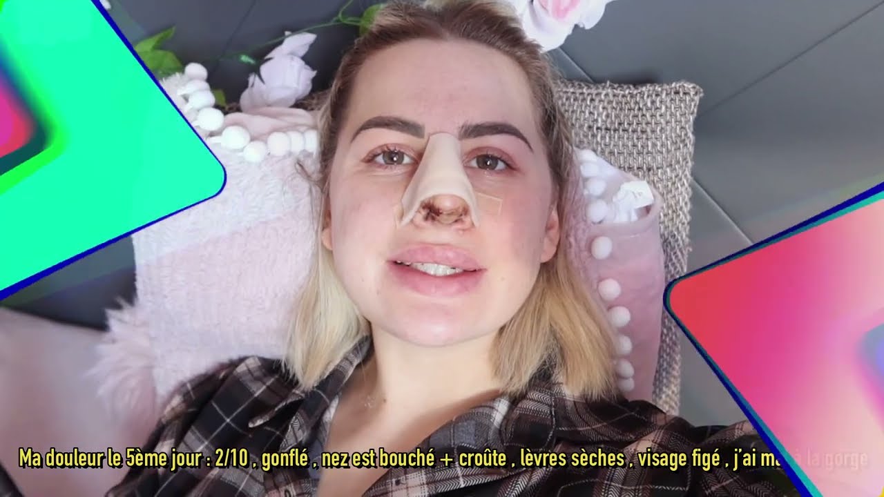 TOUT SUR MA RHINOPLASTIE ~ VLOG ~