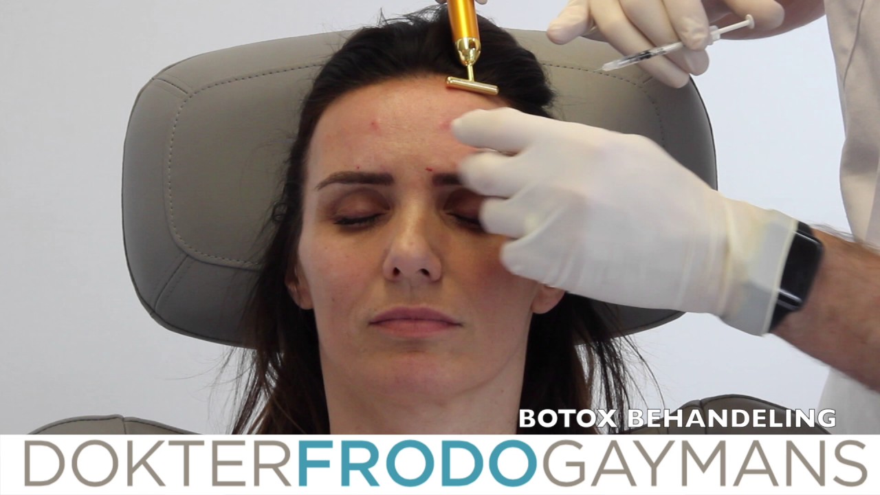 Botox behandeling frons voorhoofd en kraaienpootjes