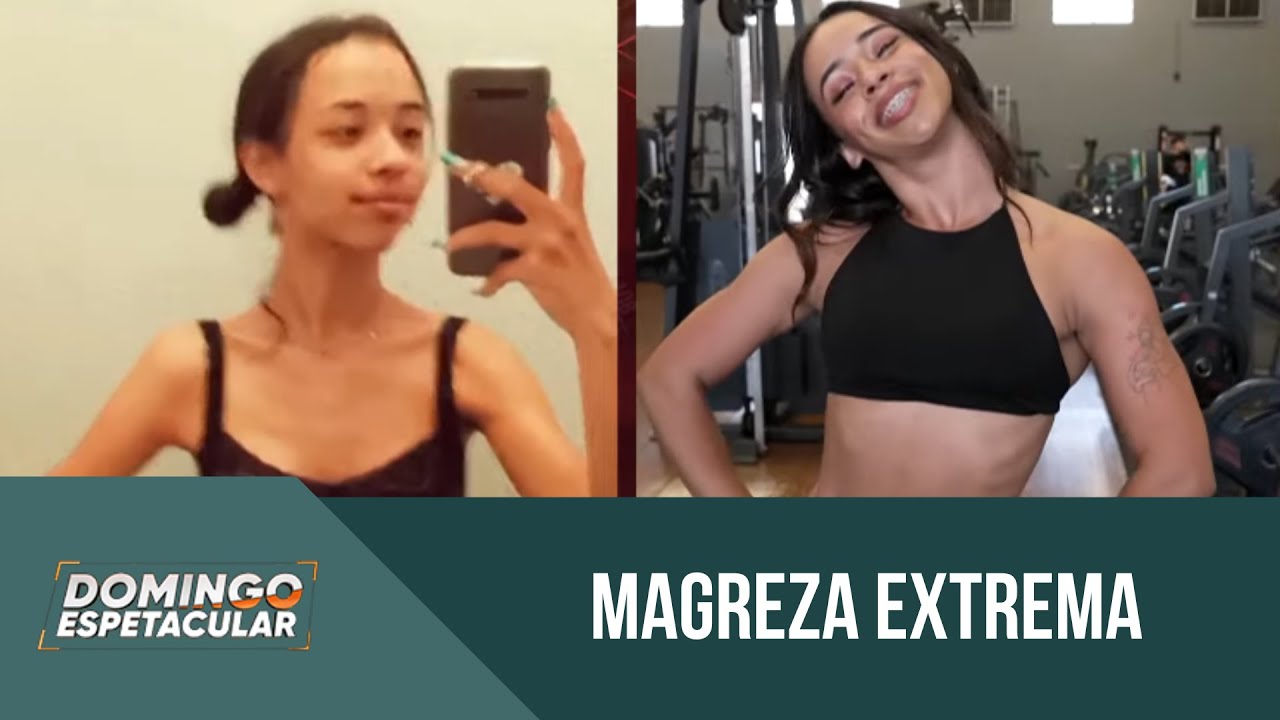 Valorização da magreza extrema gera preocupação entre profissionais da saúde | 'Domingo Espetacular'