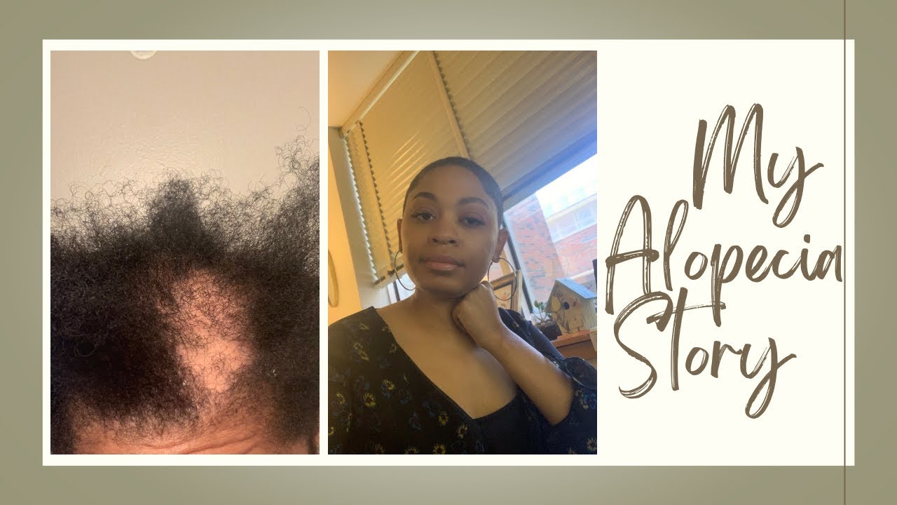 My Alopecia Story (Finally Cutting My Hair)#alopecia#bigchop