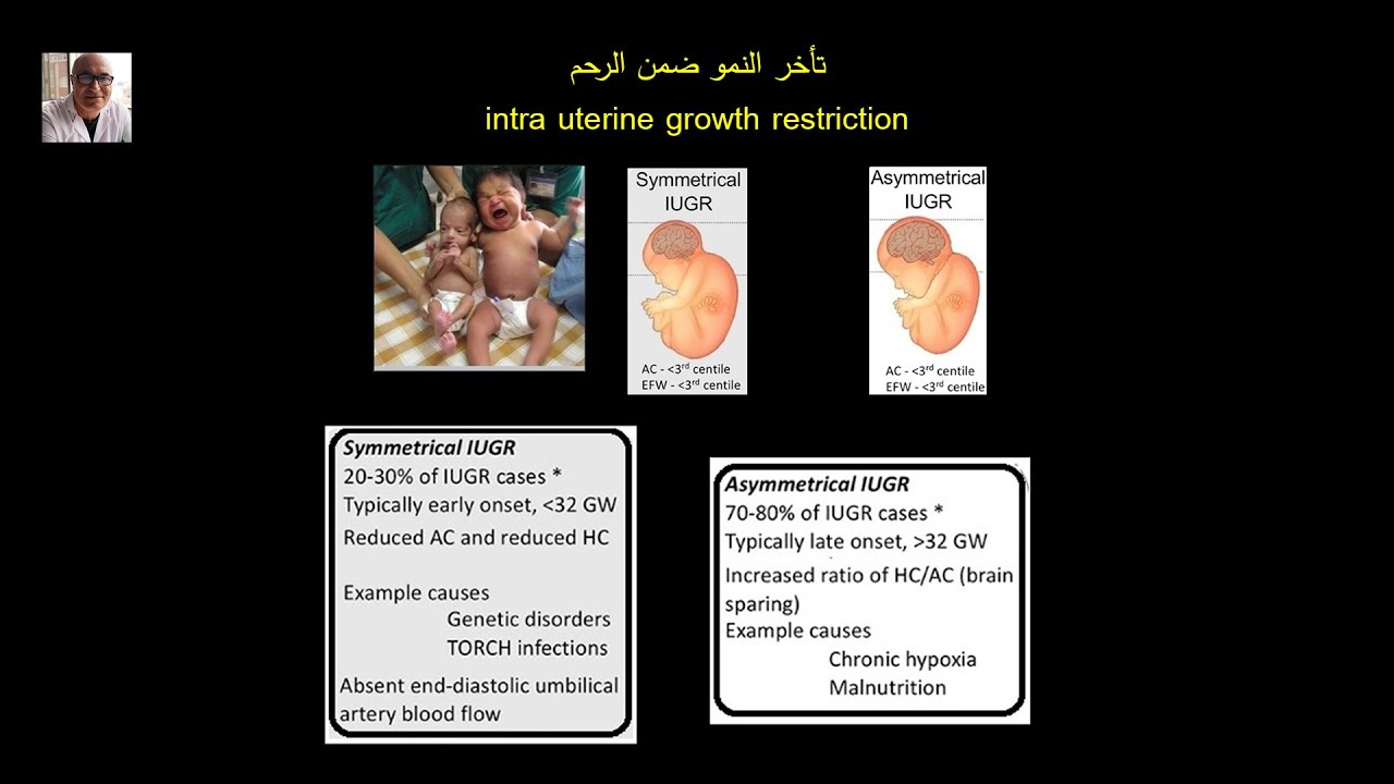 تأخر النمو ضمن الرحم     Intra uterine growth restriction