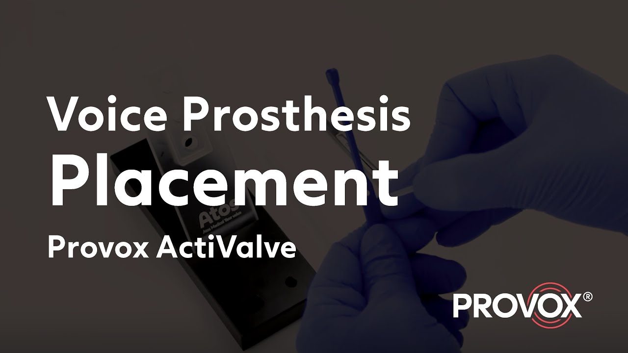 Placement of Provox ActiValve Voice Prosthesis After Laryngectomy Surgery