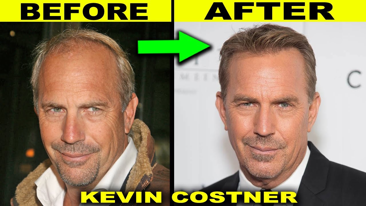 Kevin Costner 2022 Shocking Transformation – Yellowstone Actor Before and After Hair Transplant