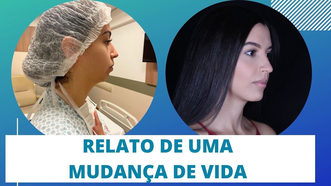 Cirurgia Ortognatica - relato de uma mudança de vida