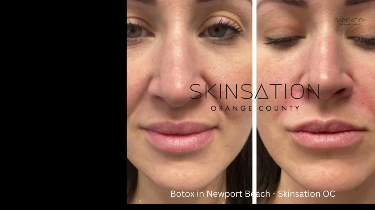 Botox in Newport Beach - Skinsation OC