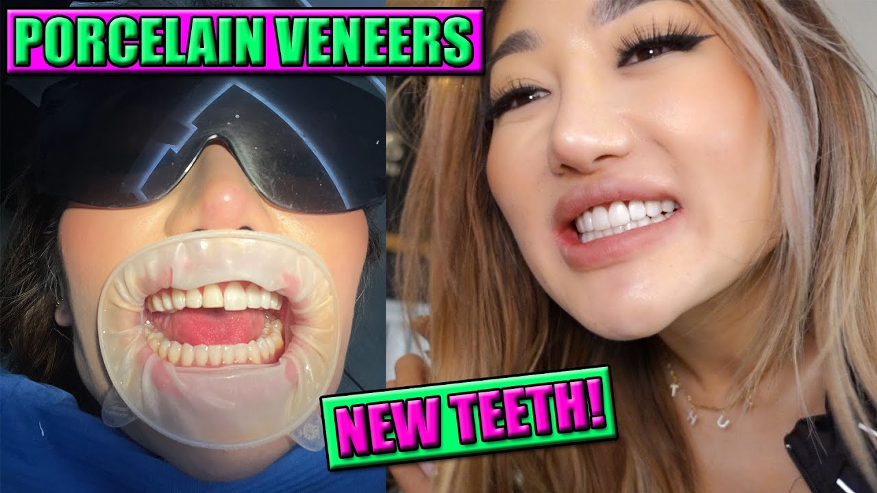 GETTING MY OFFICIAL NEW PORCELAIN VENEERS! LIFE CHANGING SMILE TRANSFORMATION!!