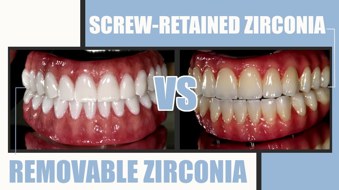 What's the Difference: Hybrid Screw-Retained Zirconia VS Removable Full-Mouth Zirconia