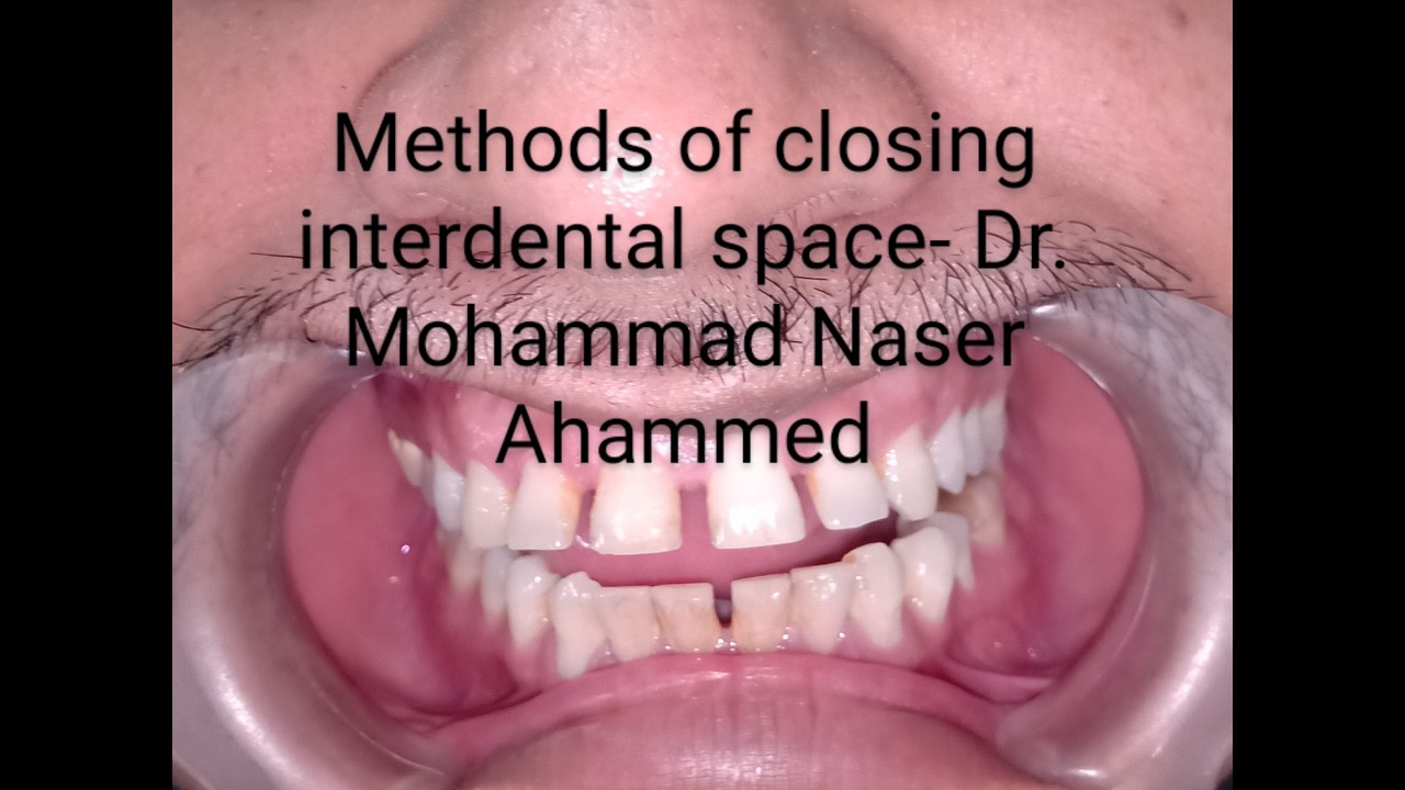 INTERDENTAL SPACE CLOSING PROCEDURES-  DR.  MOHAMMAD NASER AHAMMED ENGLISH
