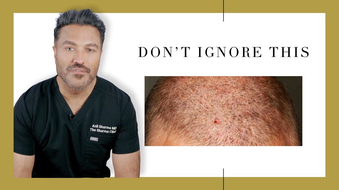 Hair Transplant Complications No One Warns You About (What To Do About Them)