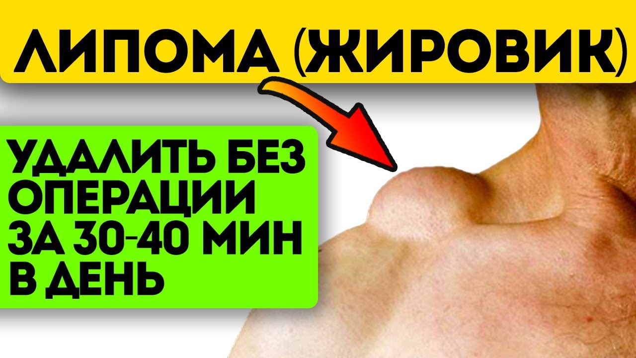 К хирургу не пойду! Народные рецепты против жировика (липомы)