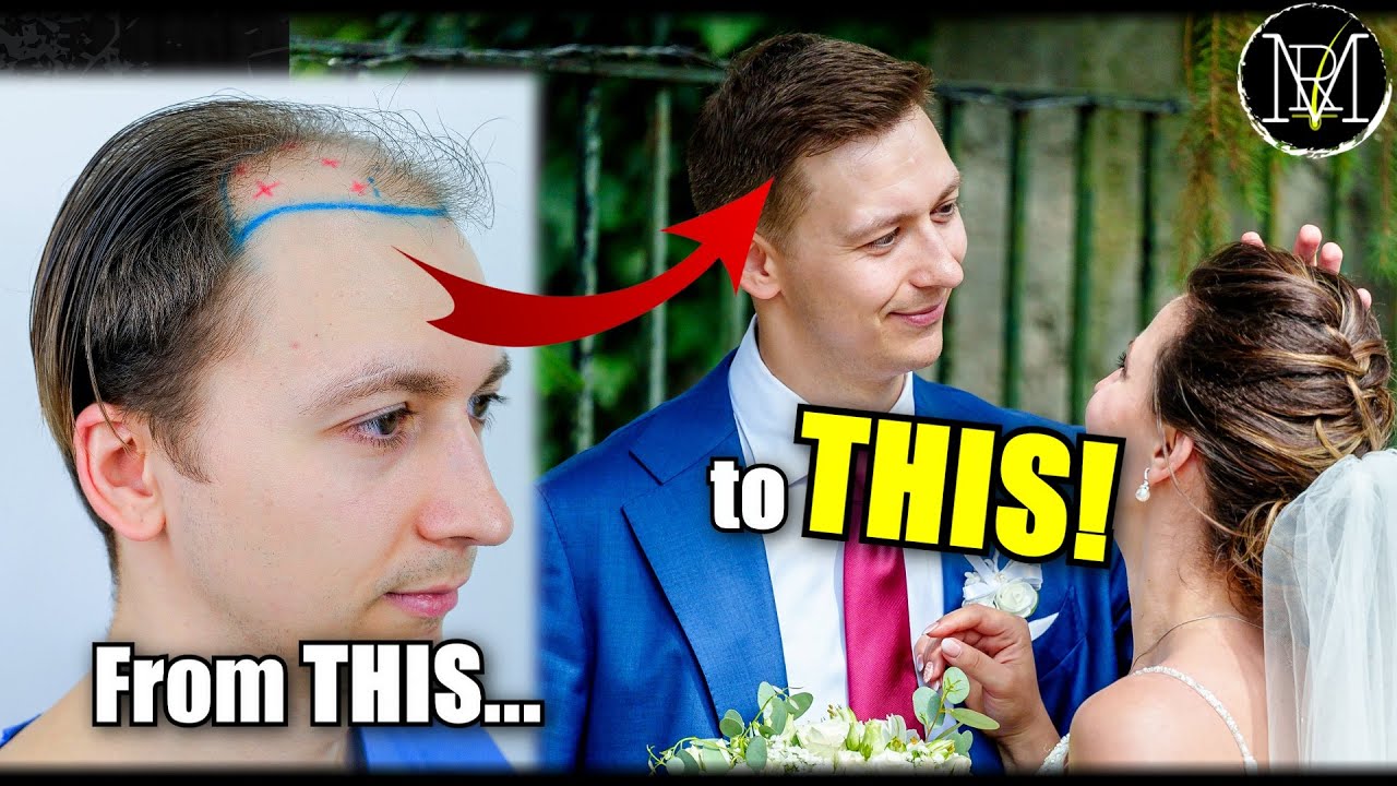 Hairline Upgrade for the Big Day!