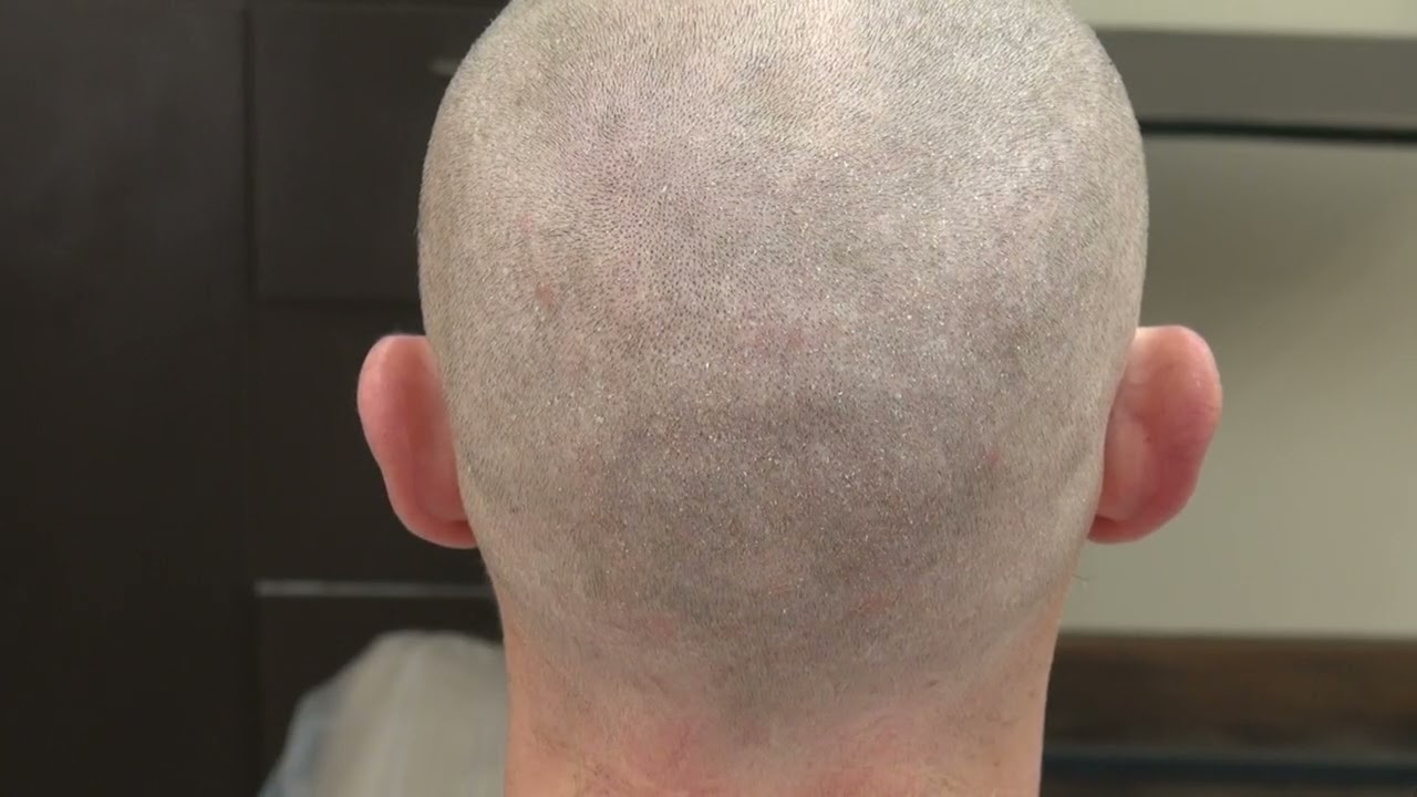 FUE Hair Transplant Scar Explained by Dr. Diep | Manual vs FUT & Natural Healing