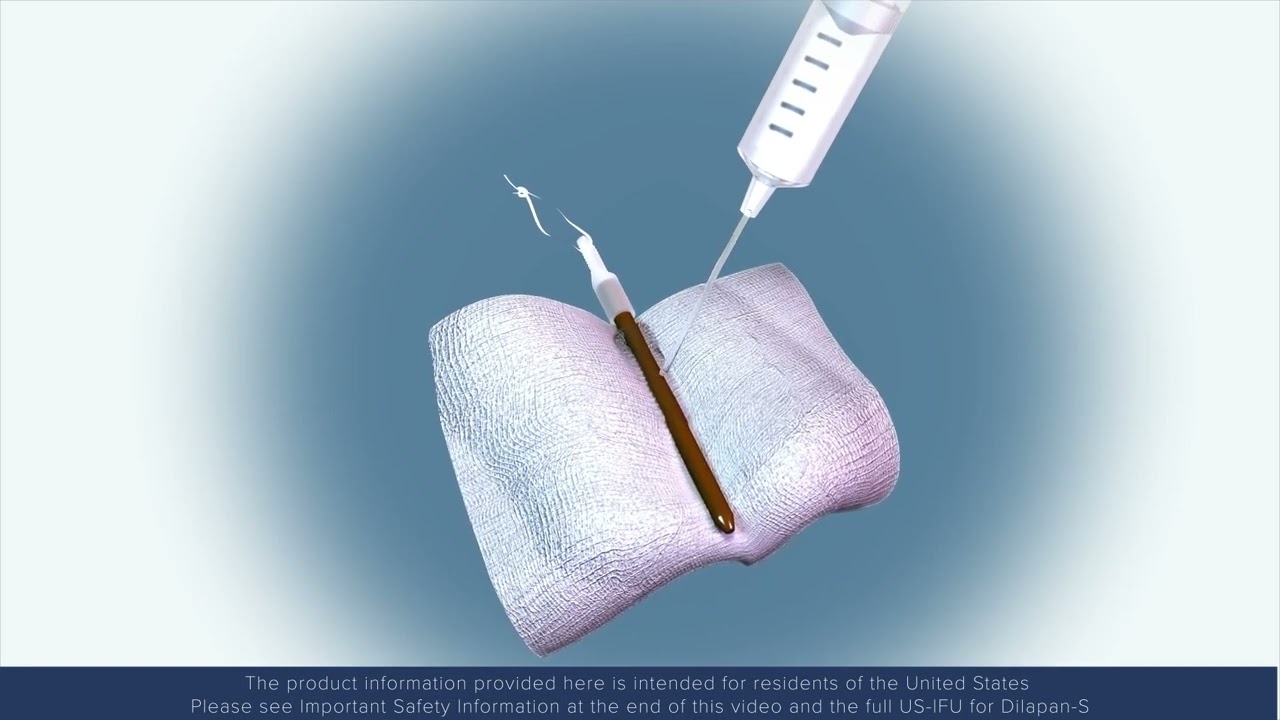 Cervical Ripening for Induction of Labor with Dilapan-S&reg;_ Instructions For Use