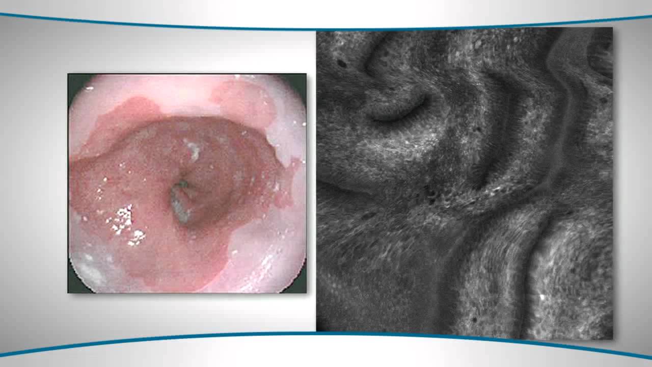 Learn About Confocal Microendoscopy