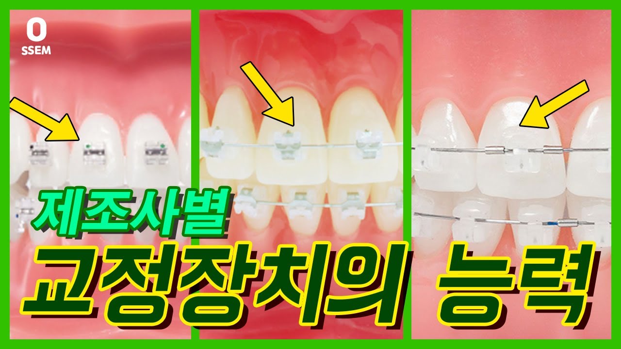 치아교정 장치 종류 (클리피씨,데이몬,세라믹,레진,메탈 브라켓)
