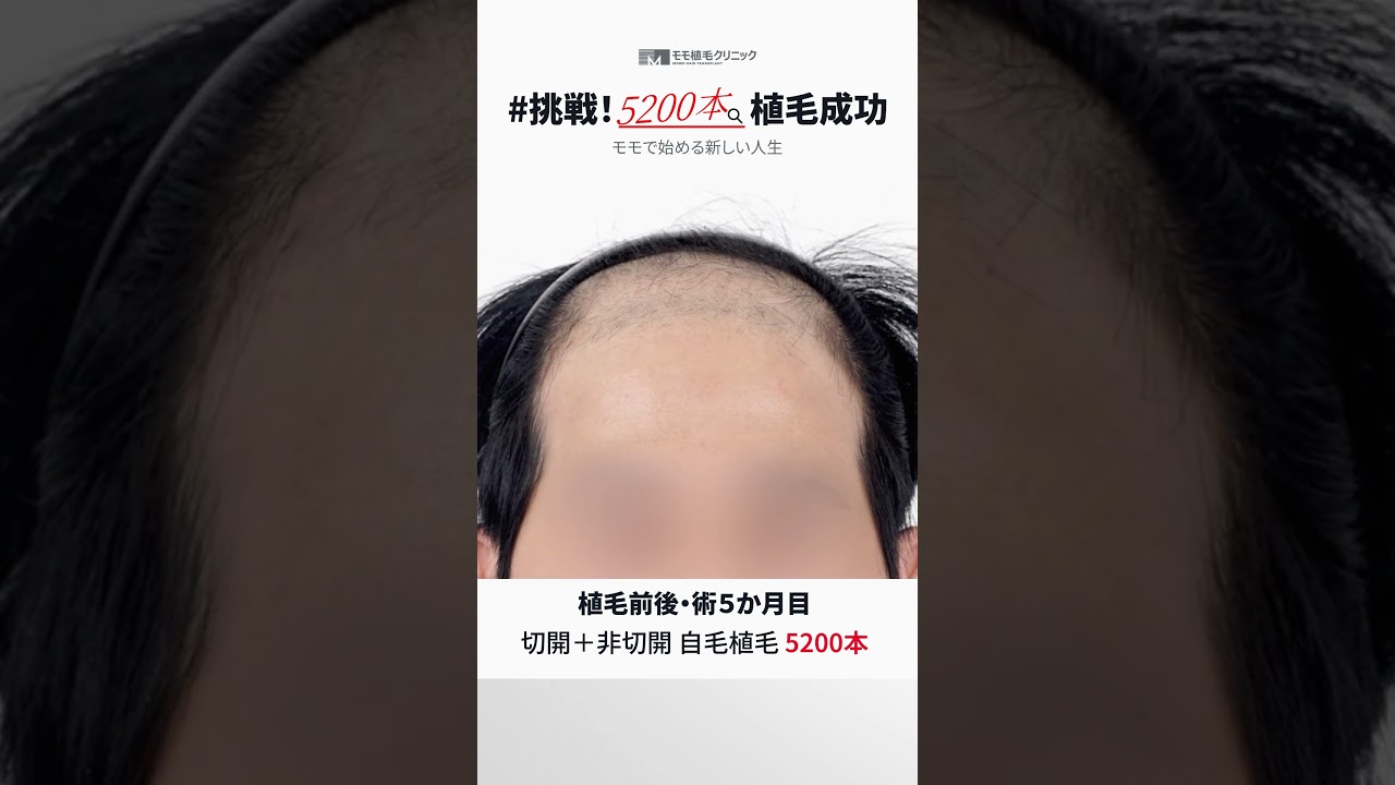 「5200本」切開+非切開自毛植毛 &rArr; 大成功😚