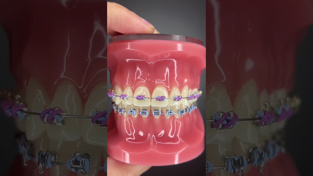 Different Types of Orthodontic Ties you can get at your Orthodontist Part 2