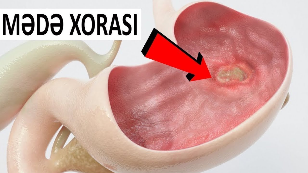 Yeməkdən sonra mədənizdə ağrı varsa - BAXIN
