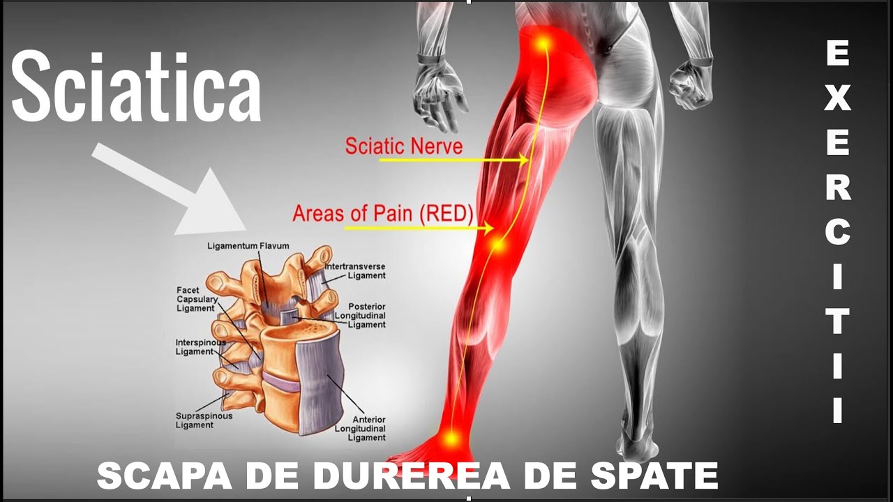 EXERCITII PENTRU SCIATICA, SINDROM DE PIRIFORM (DURERI DE SPATE)