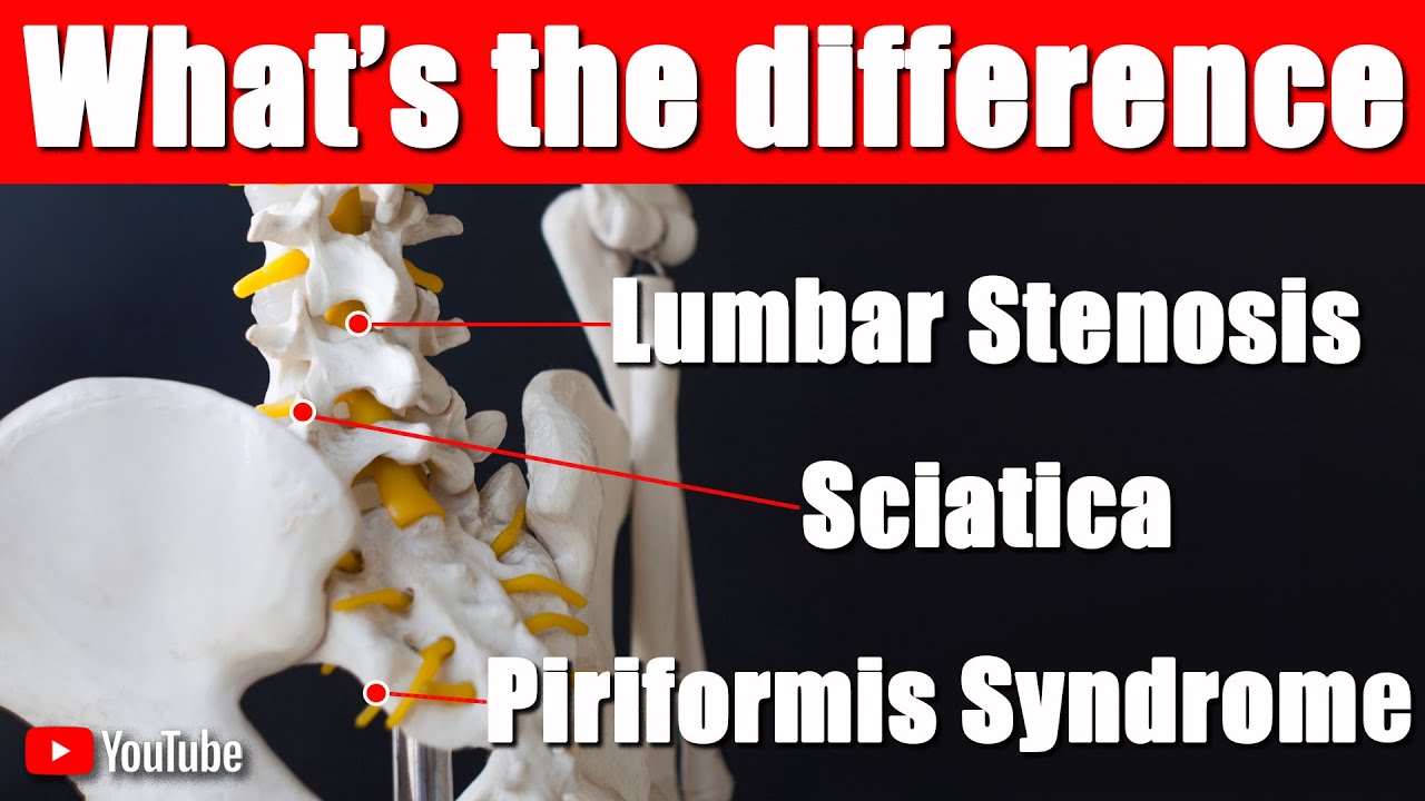 Страдаете ли вы ишиасом, синдромом грушевидной мышцы или поясничным стенозом? Как отличить