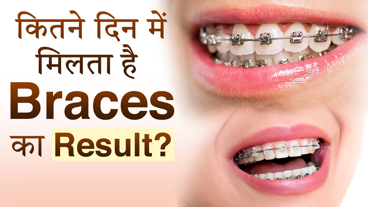 Braces Ka Result Kitne Din Me Milta Hai? 😬 Full Timeline Explained