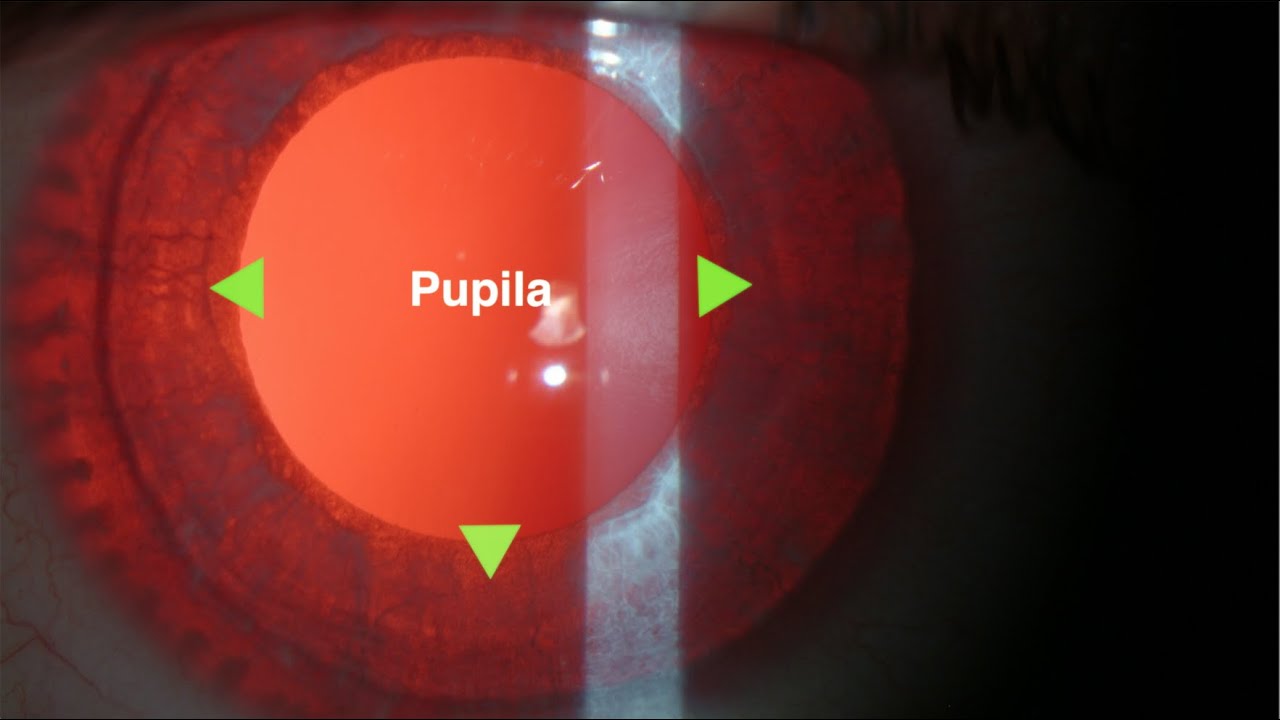 El color de los ojos: ojos albinos y ojos azules