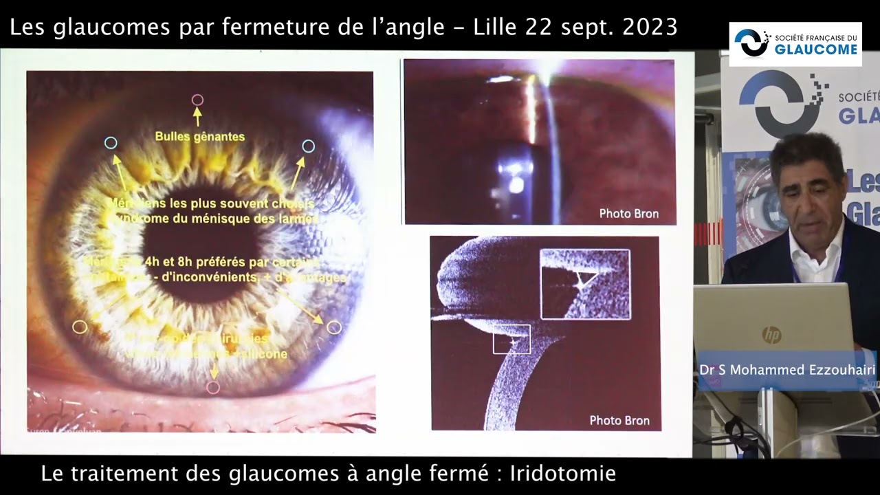Iridotomie Dr S Mohammed Ezzouhairi