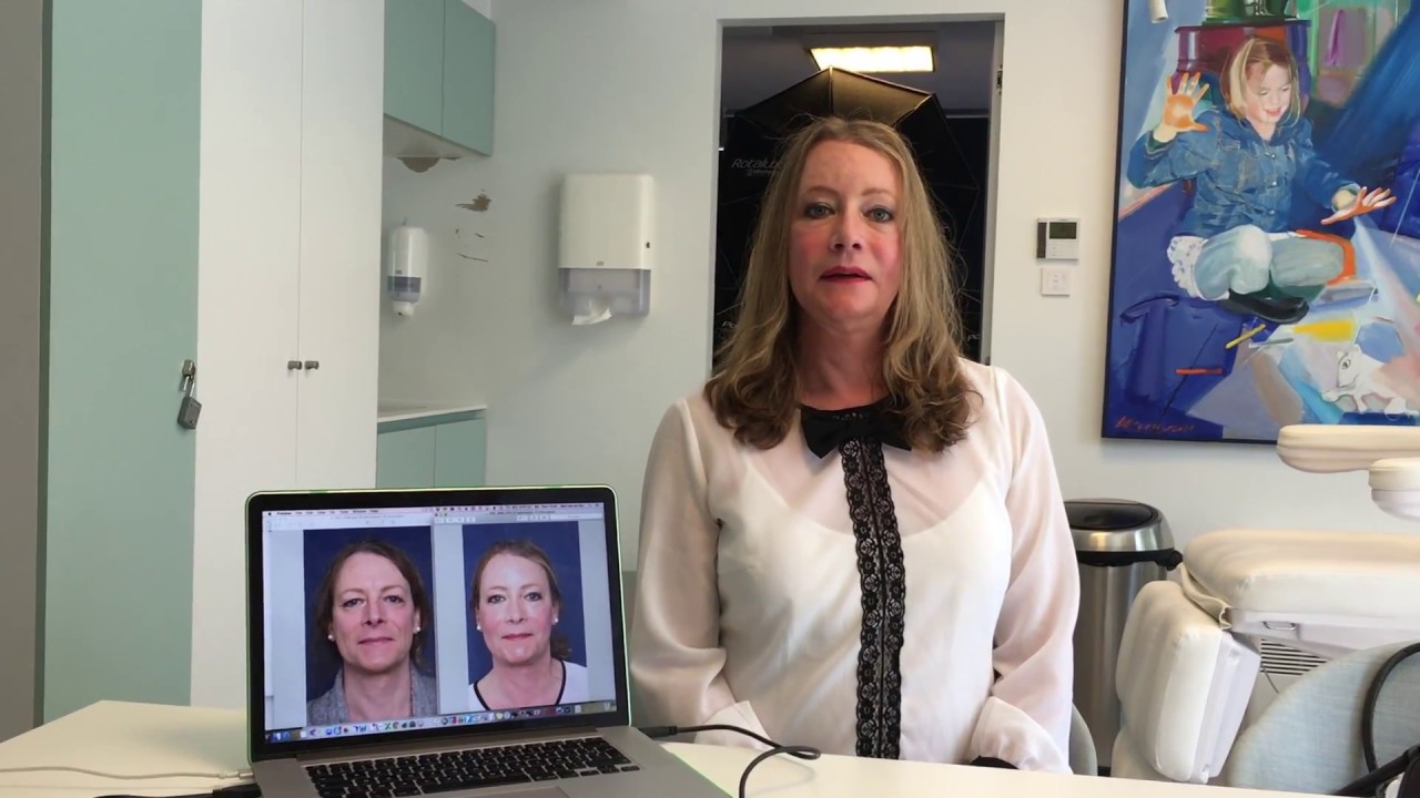 Facial Feminization Surgery Review - Felicitas (English subtitles), Dr Bart van de Ven reviews