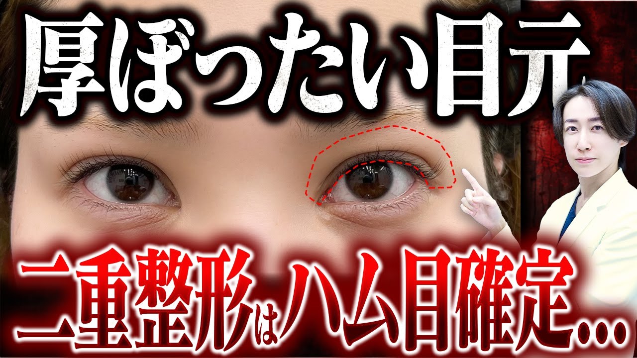 【20代向け眉下切開】二重整形ではカバーできない