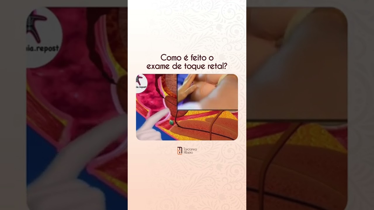 Como &eacute; feito o exame de toque retal? Dra. Tarcianna l Proctologista