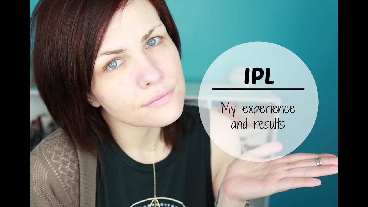IPL For Acne Scars |My Experience + Before and After|