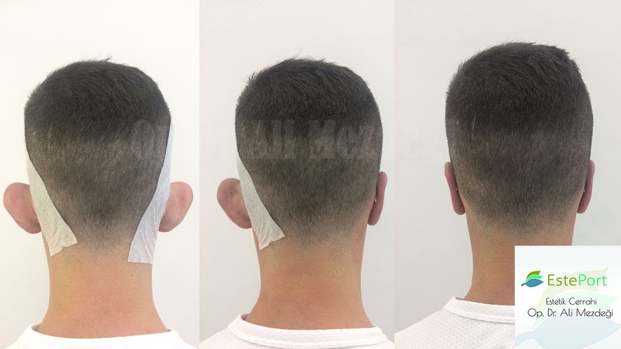 Kepçe Kulak Estetiği Öncesi ve Sonrası (2017- 2018)