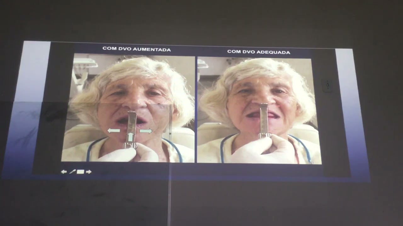 25. Relações intermaxilares em PPR. Prof. Eduardo Chorres DOL UFS 03 04 2023