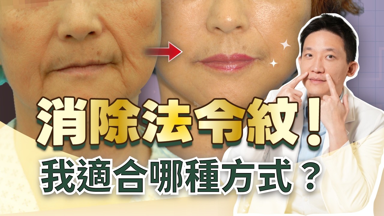 法令紋怎麼消除？先診斷法令類型 對症下藥才有用！｜新聖整形外科 林子宇醫師