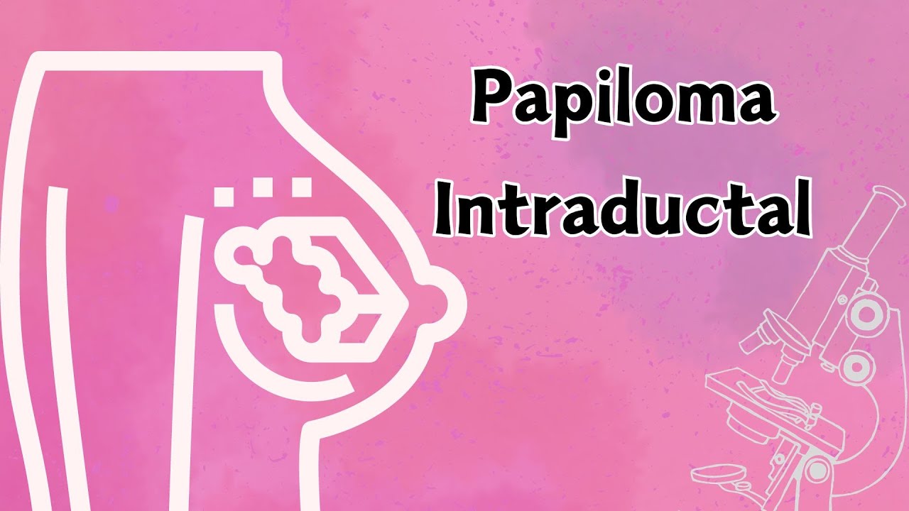 Papiloma Intraductal. Patología mamaria