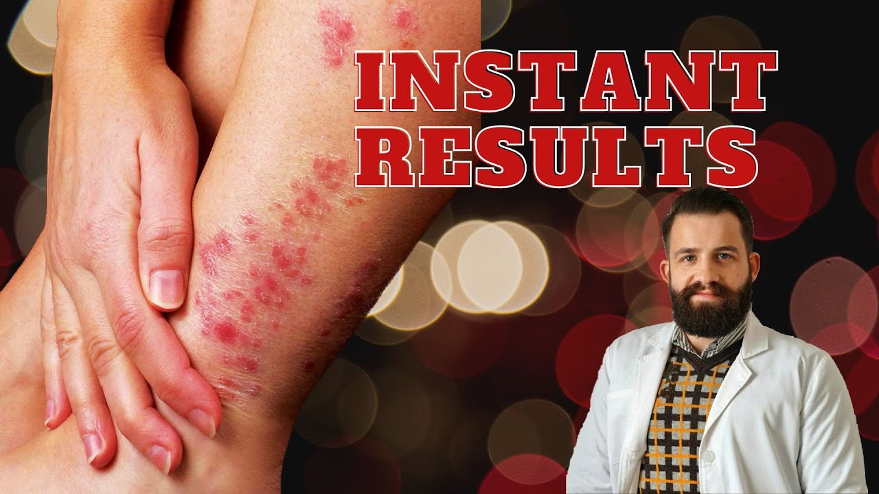 How Master Tung Acupuncture Helped Treat Psoriasis and Anxiety: A Patient Success Story