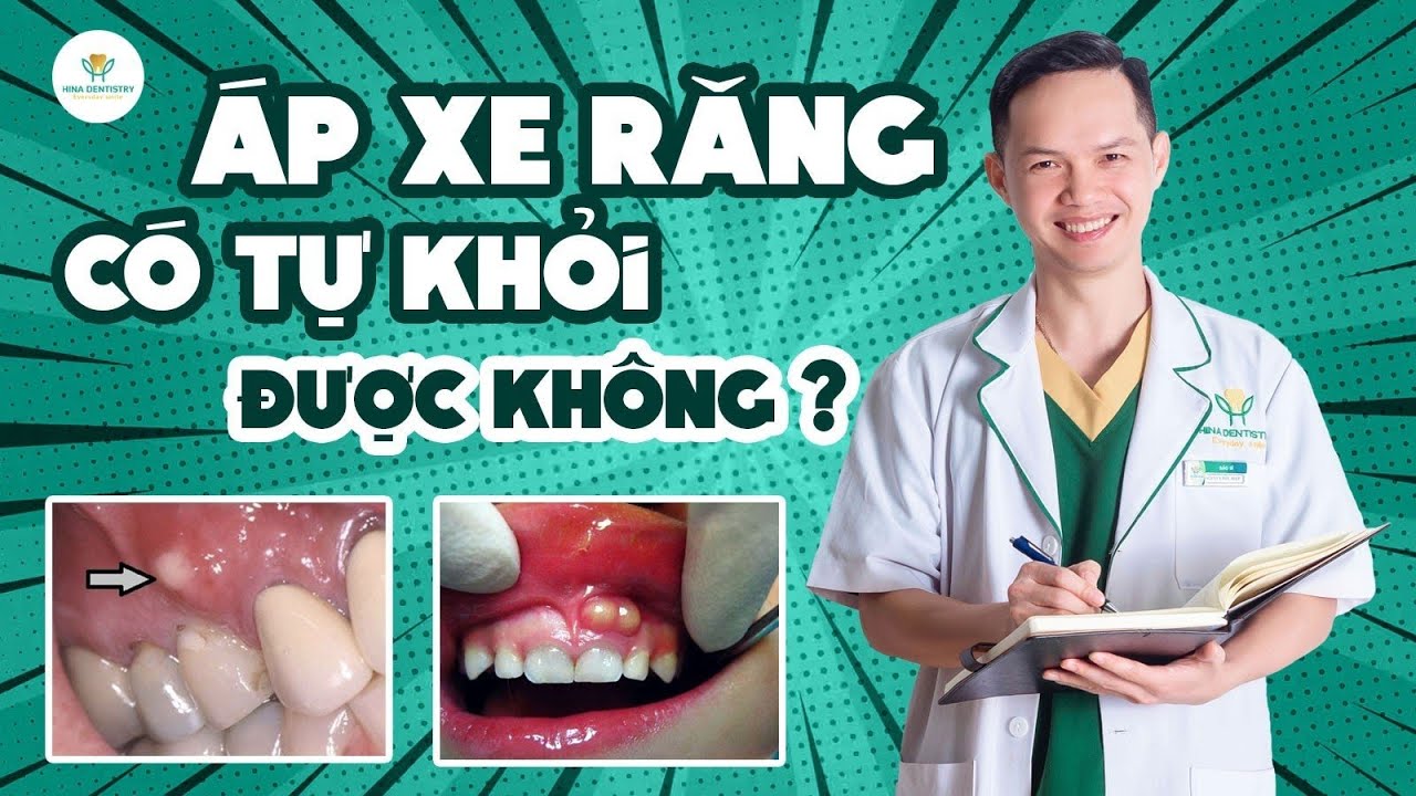 Áp Xe Chân Răng: Có Tự Khỏi Được Hay Cần Điều Trị | Nha Khoa Hina
