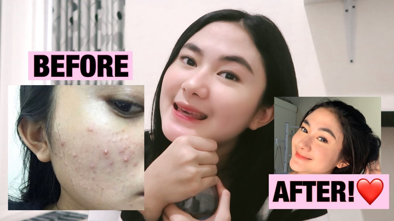 My Skin Journey: 