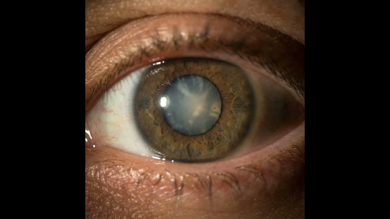 What Does Glaucoma Look Like