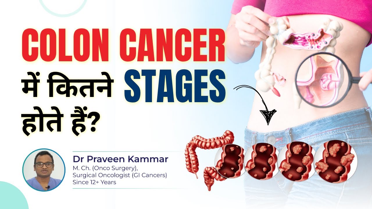 Colon Cancer में कितने Stages होते हैं? | Colon Cancer Explained by GI Cancer Surgeon | Dr Praveen