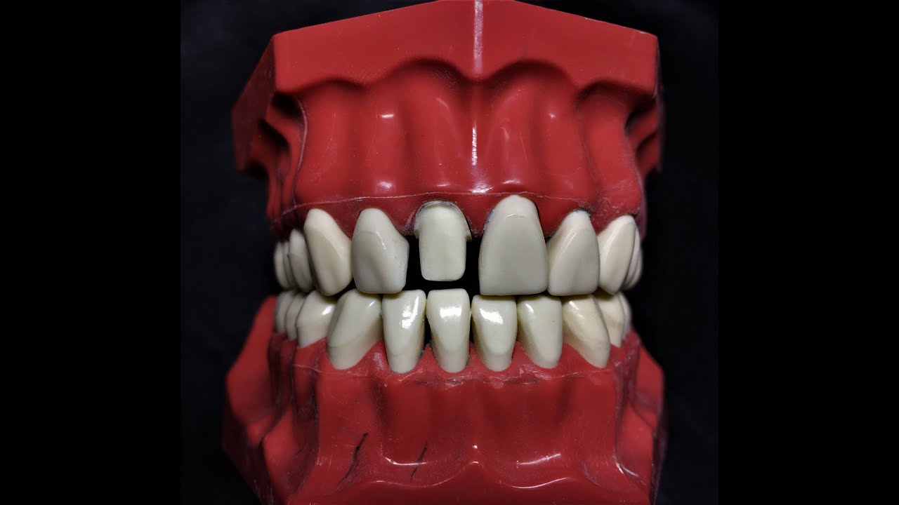 Fantom Çene Maksiller Santral Diş Preparasyonu - Phantom Jaw Upper Sentral Teeth Preparation