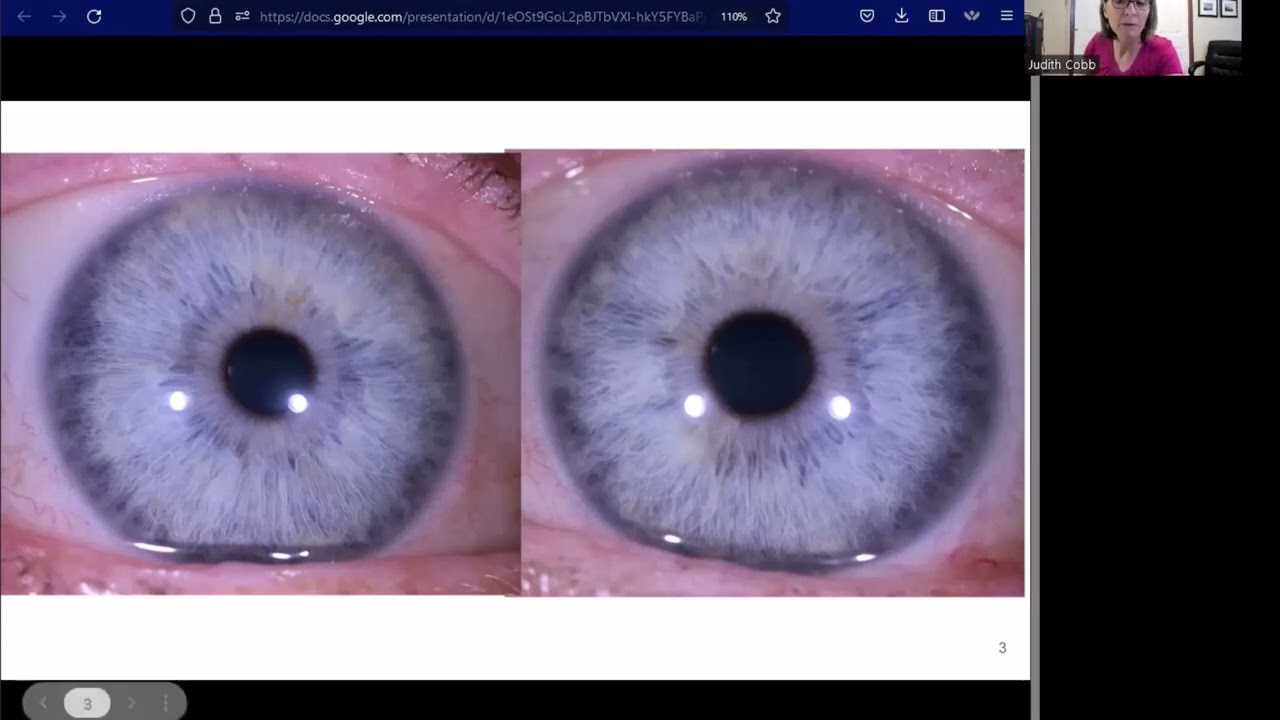 Iridology: Iris Fiber...transversals