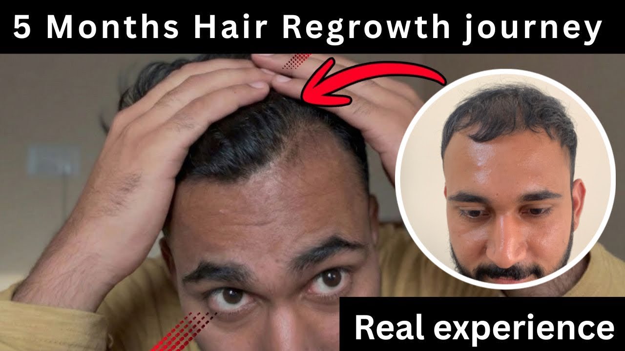 5 Months Hair Regrowth – I Can’t Believe These Results 😱 (Real Proof)